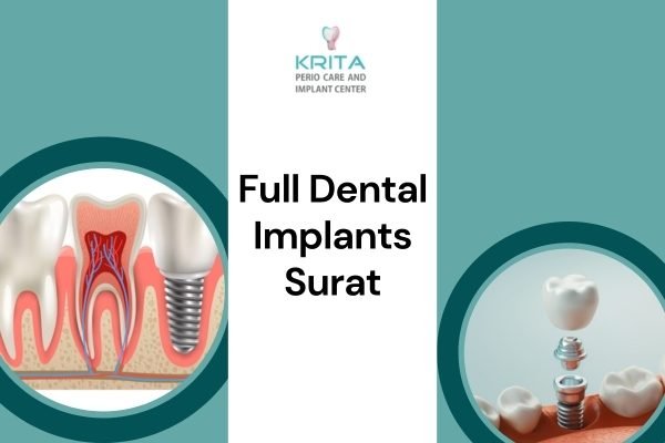 Full Dental Implants Surat dental implants